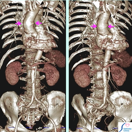 大動脈弁輪基部拡張症画像