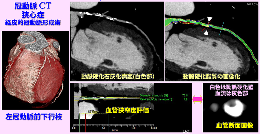 狭心症の冠動脈CT