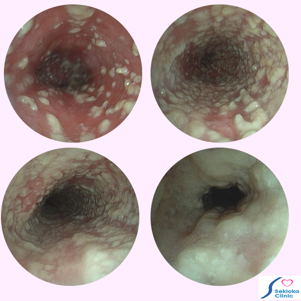 食道カンジダ症