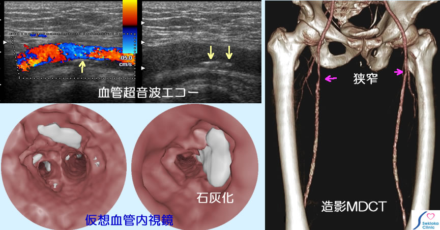 糖尿病血管病変　MDCT画像