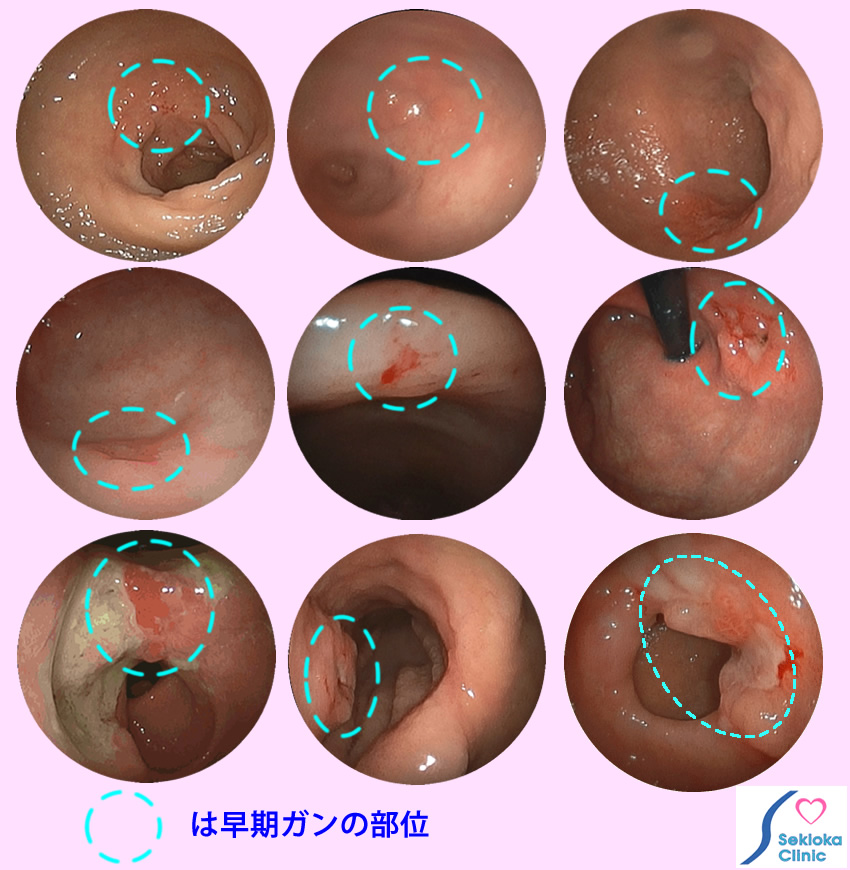 早期胃がん　内視鏡