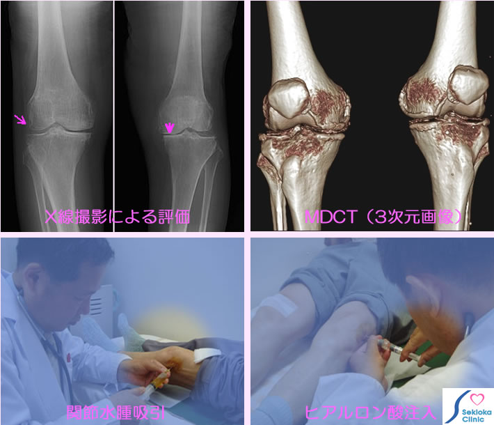 膝関節症　診断と治療
