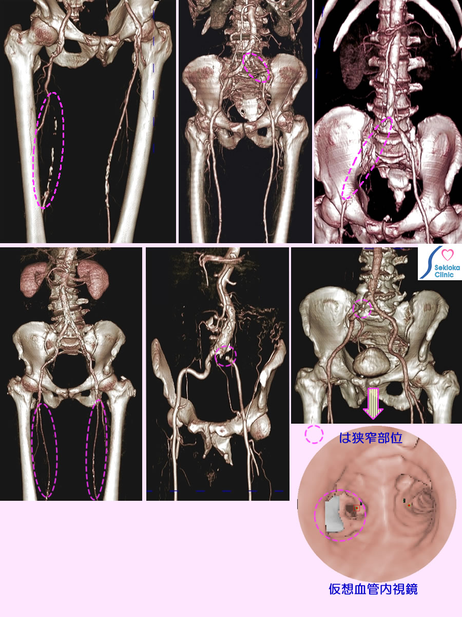 閉塞性動脈硬化症