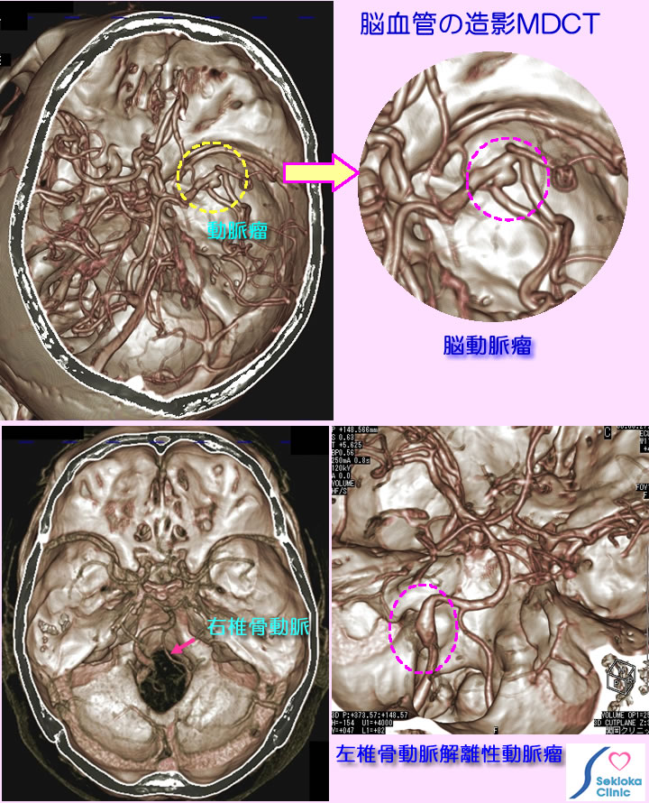 脳血管の病気NDCT造影検査
