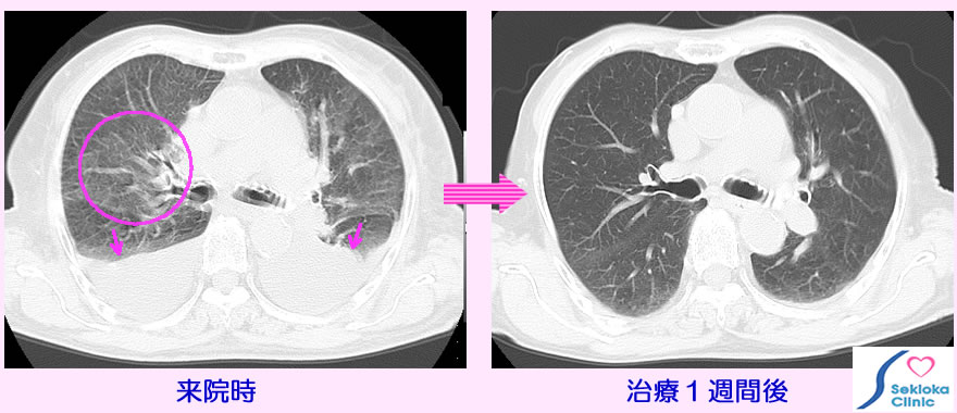 心不全CT治療前後