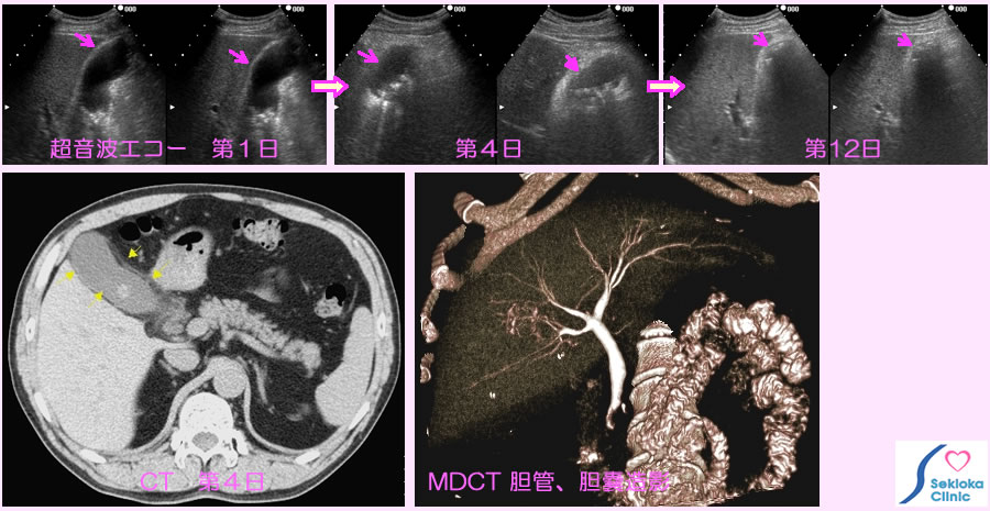 胆嚢炎　診断画像