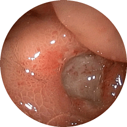 十二指腸潰瘍１