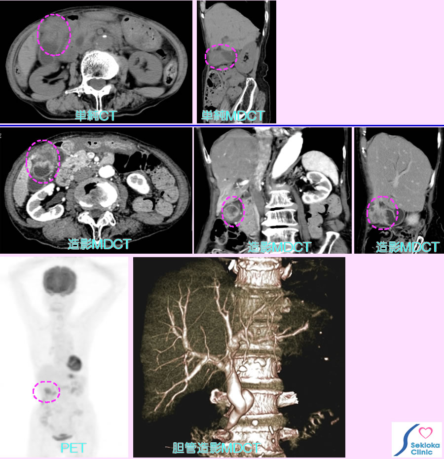 胆のうがん　MDCT、PET-CT