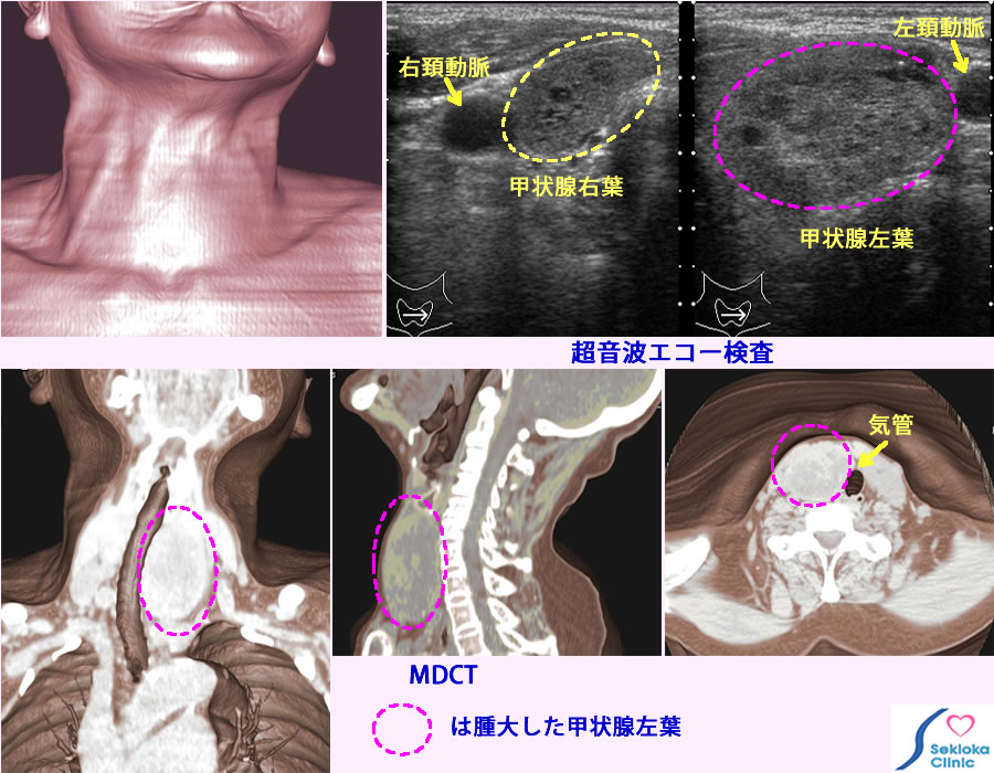 甲状腺腫　診断画像