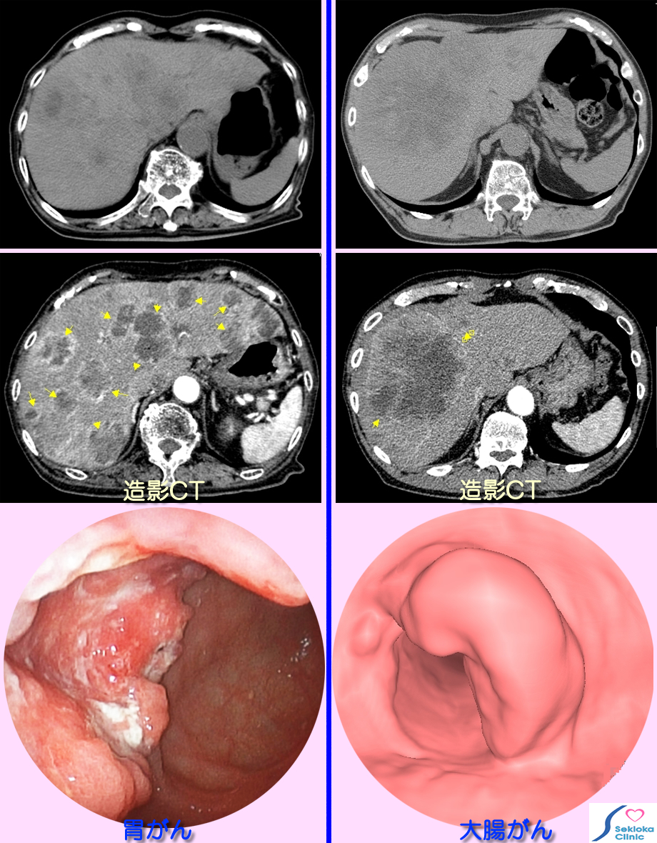 肝臓へのがん転移