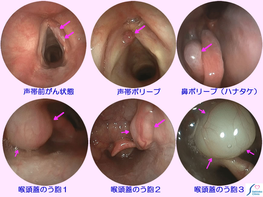 喉頭・鼻の病気　内視鏡