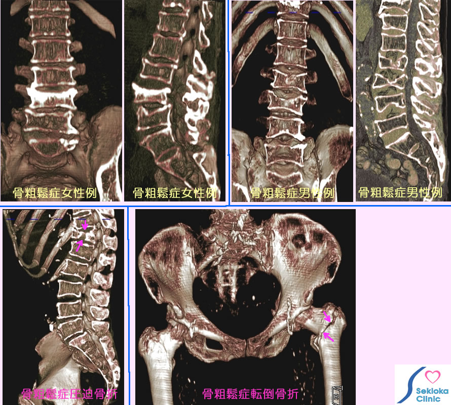 骨粗鬆症　診断と治療