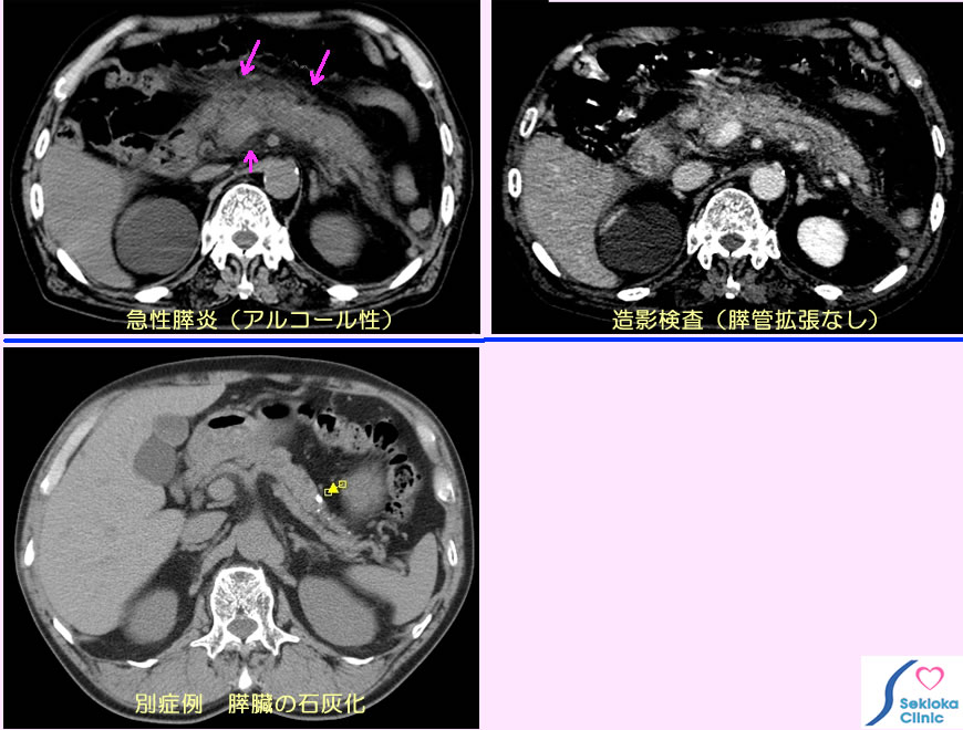 急性膵炎　CT所見