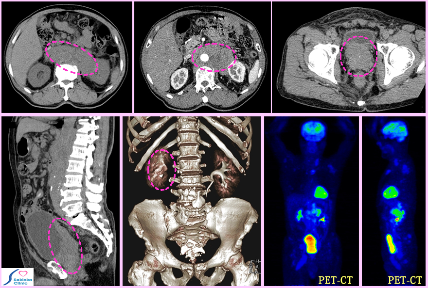 前立腺癌　転移
