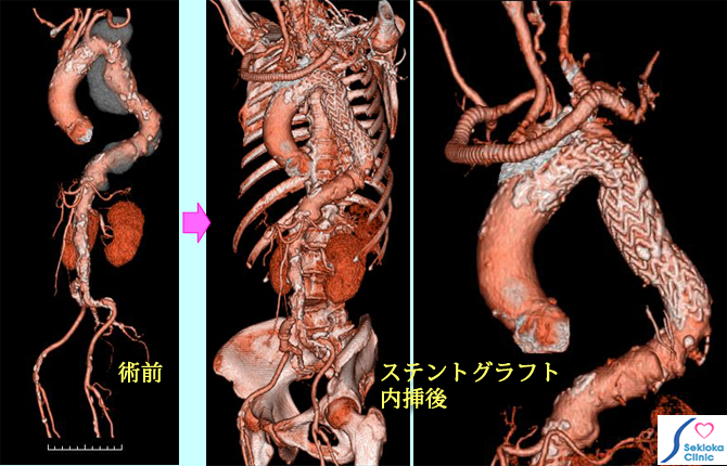 胸部動脈瘤ステントグラフトバイパス併用hybrid術