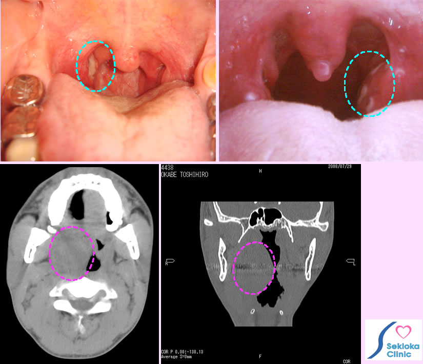 扁桃腺炎　周囲膿瘍