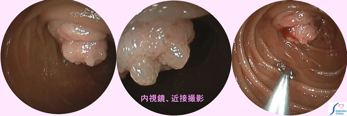 十二指腸乳頭がん