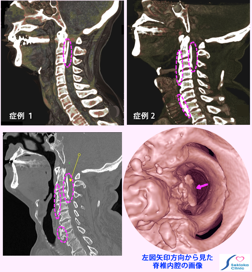 後縦靭帯・前縦靭帯骨化症
