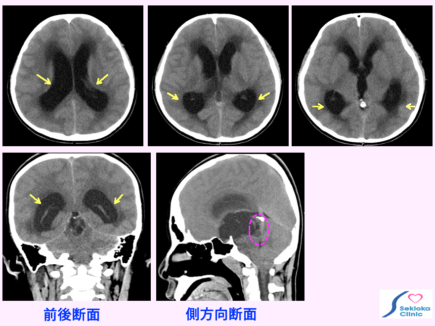 松果体胚細胞腫